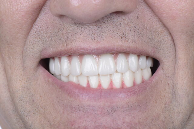 Close-up of patient smile restoration