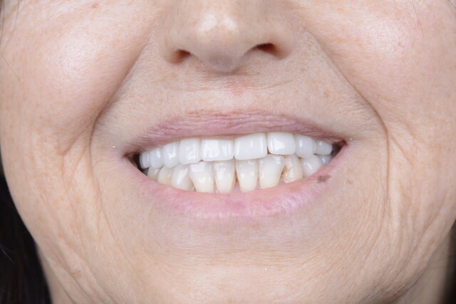 Close-up of patient smile restoration