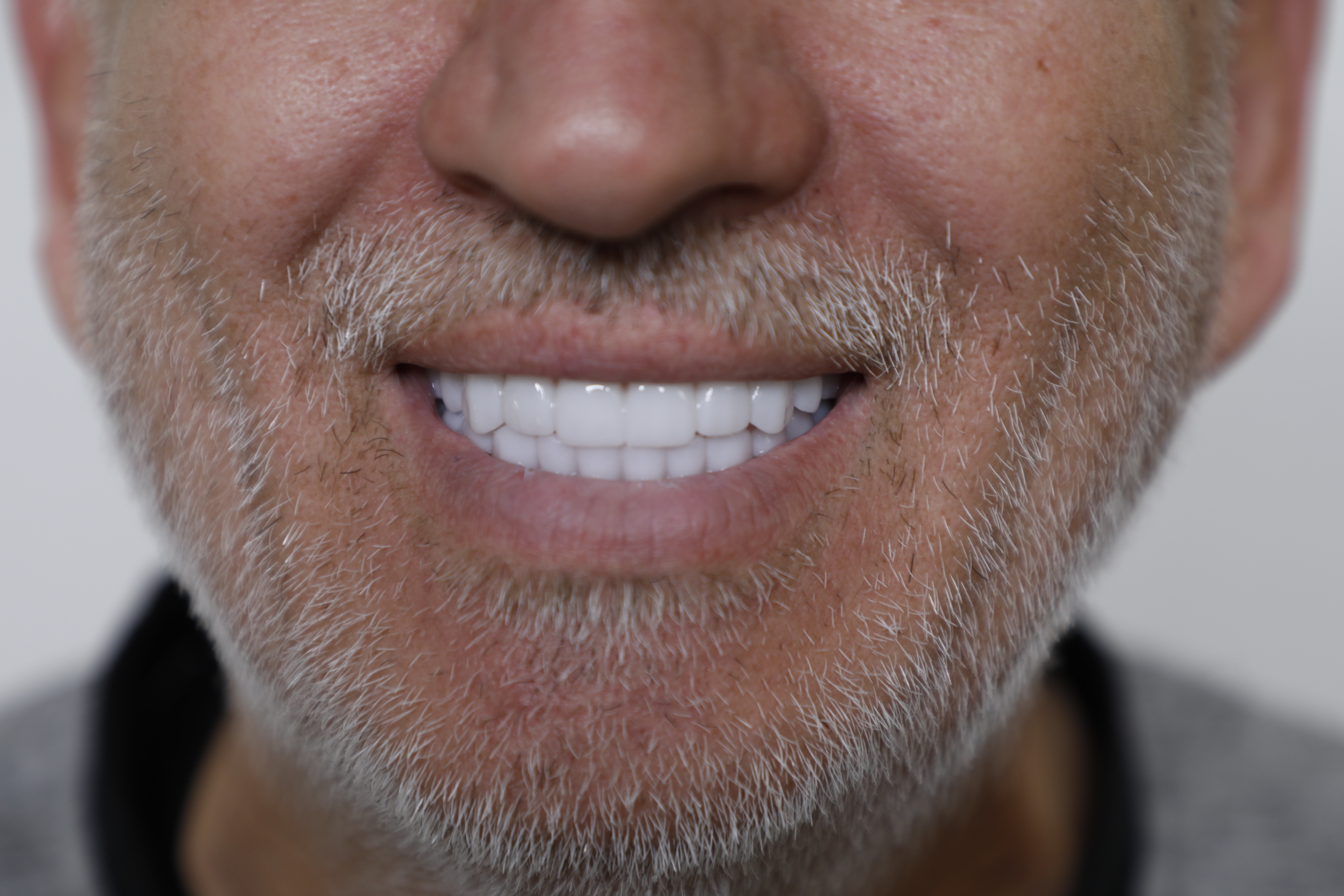 Clinical close-up of dental implants