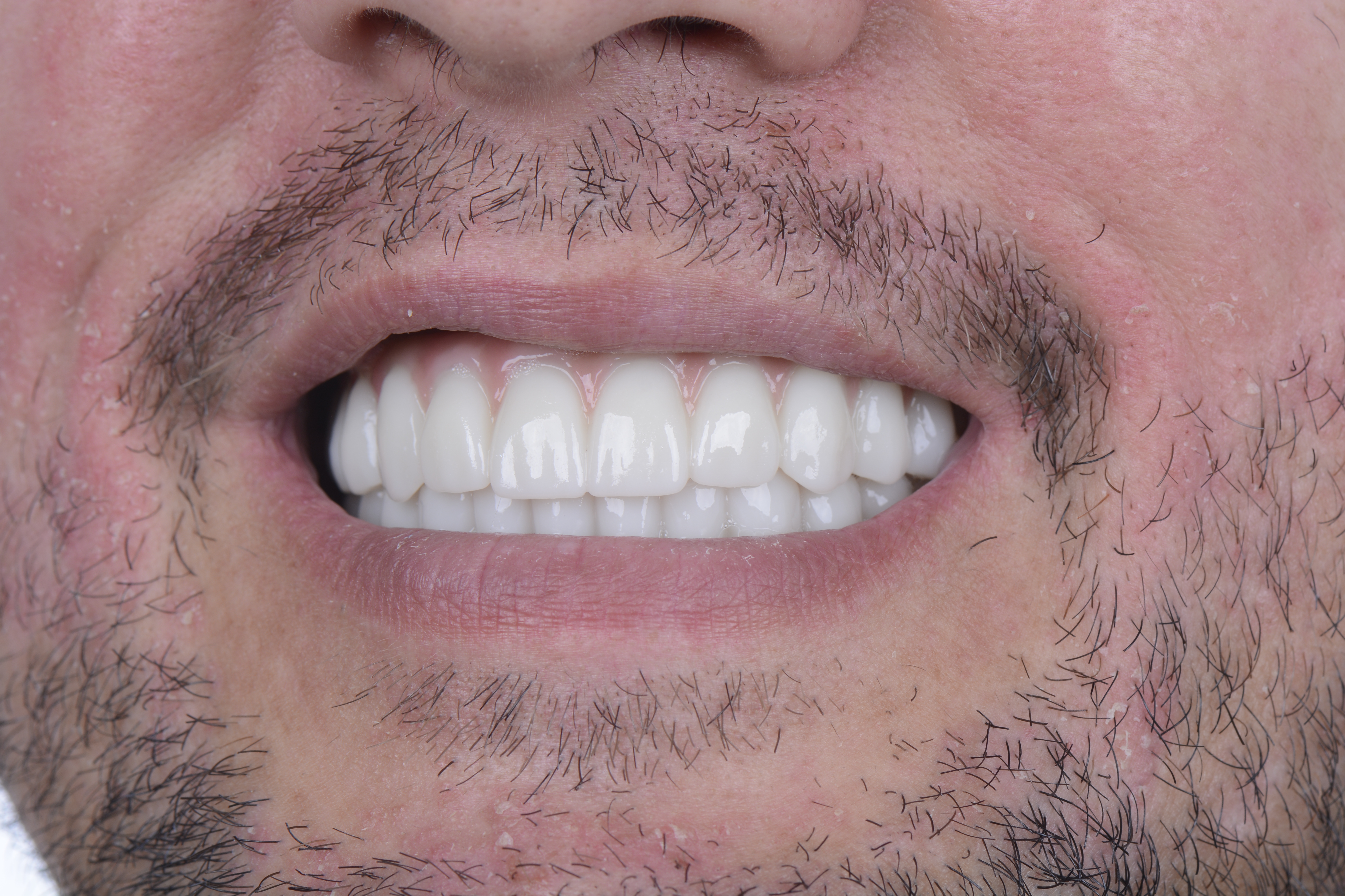 Clinical close-up of dental implants