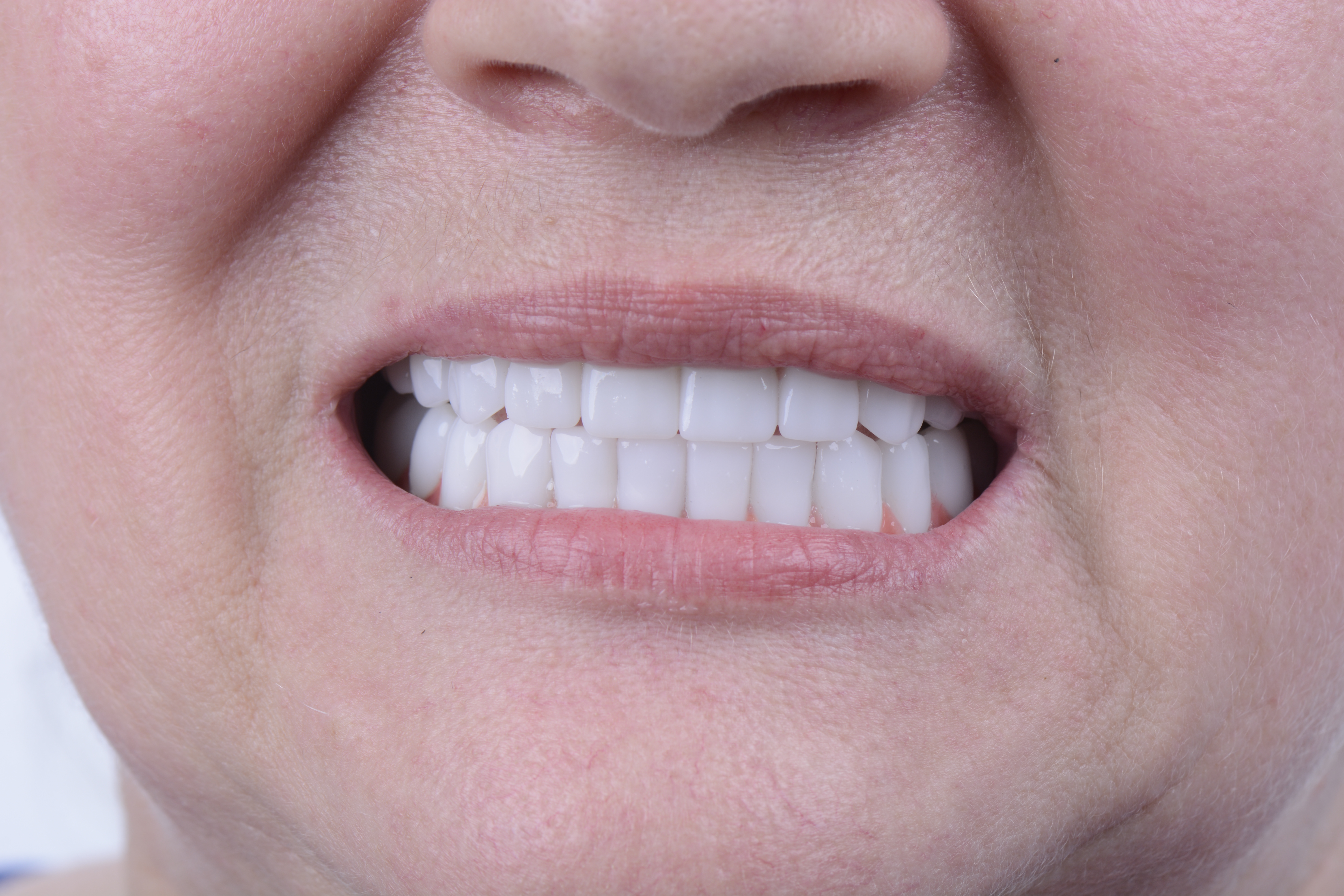 Clinical close-up of dental implants