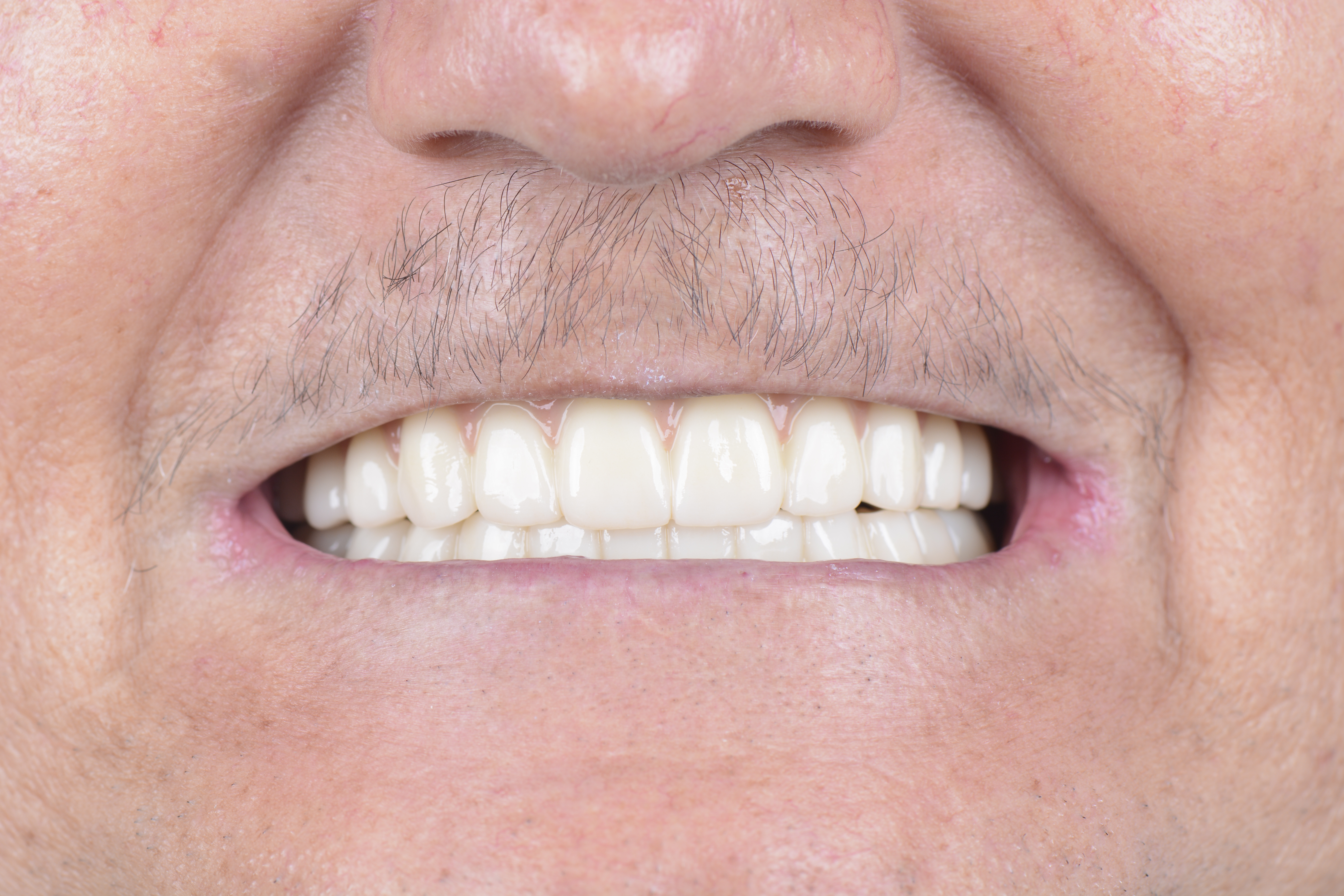 Clinical close-up of dental implants