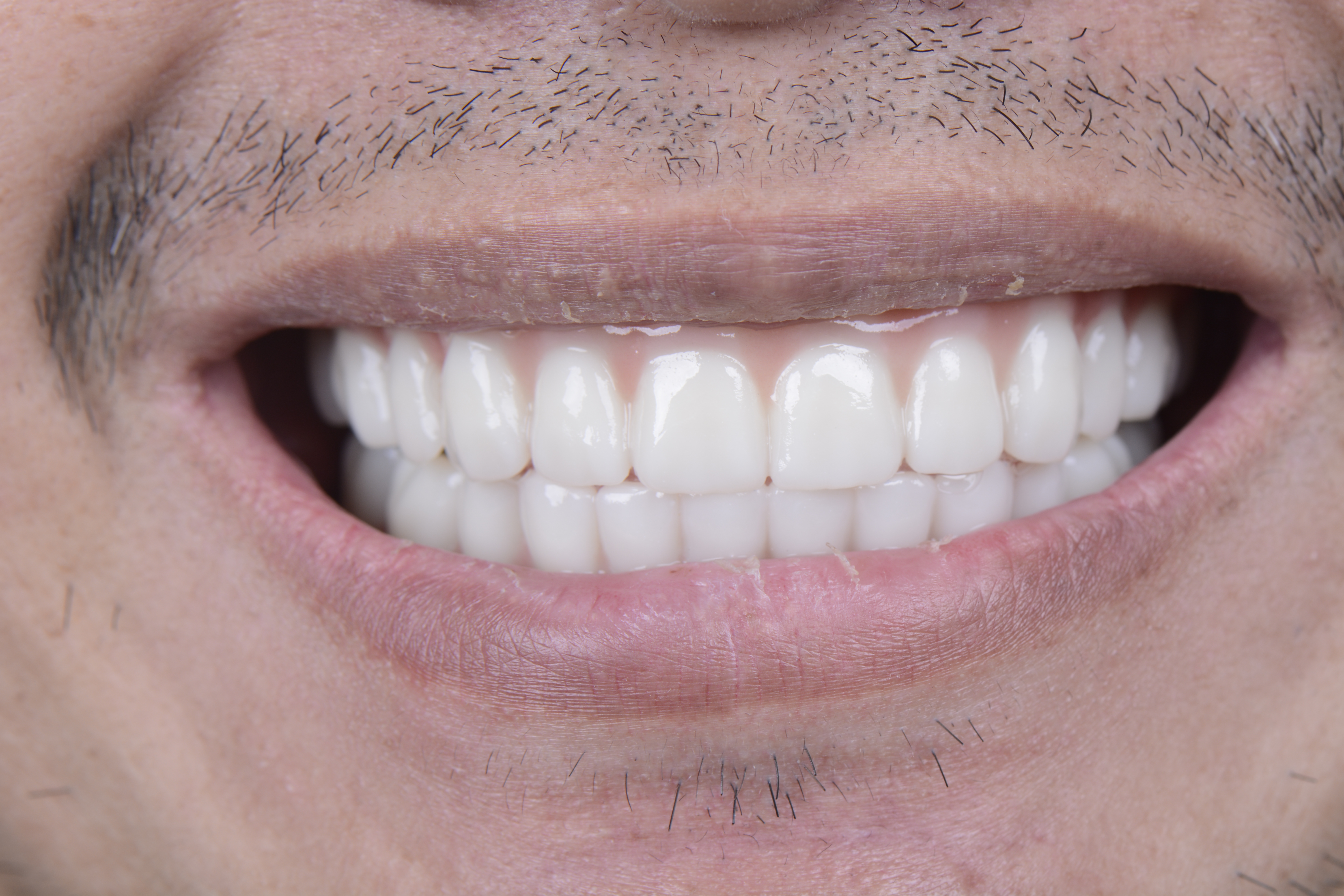 Clinical close-up of dental implants