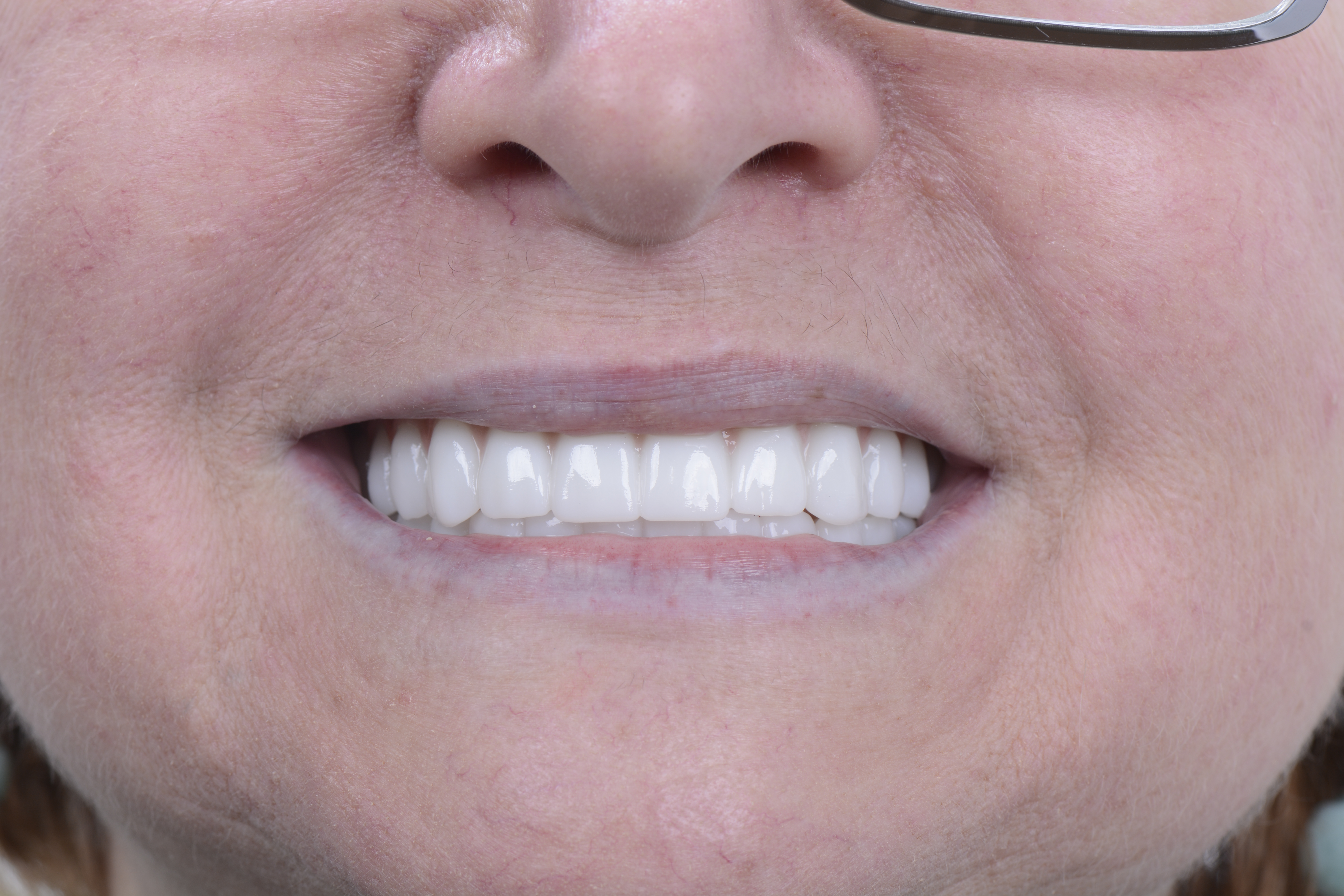 Clinical close-up of dental implants