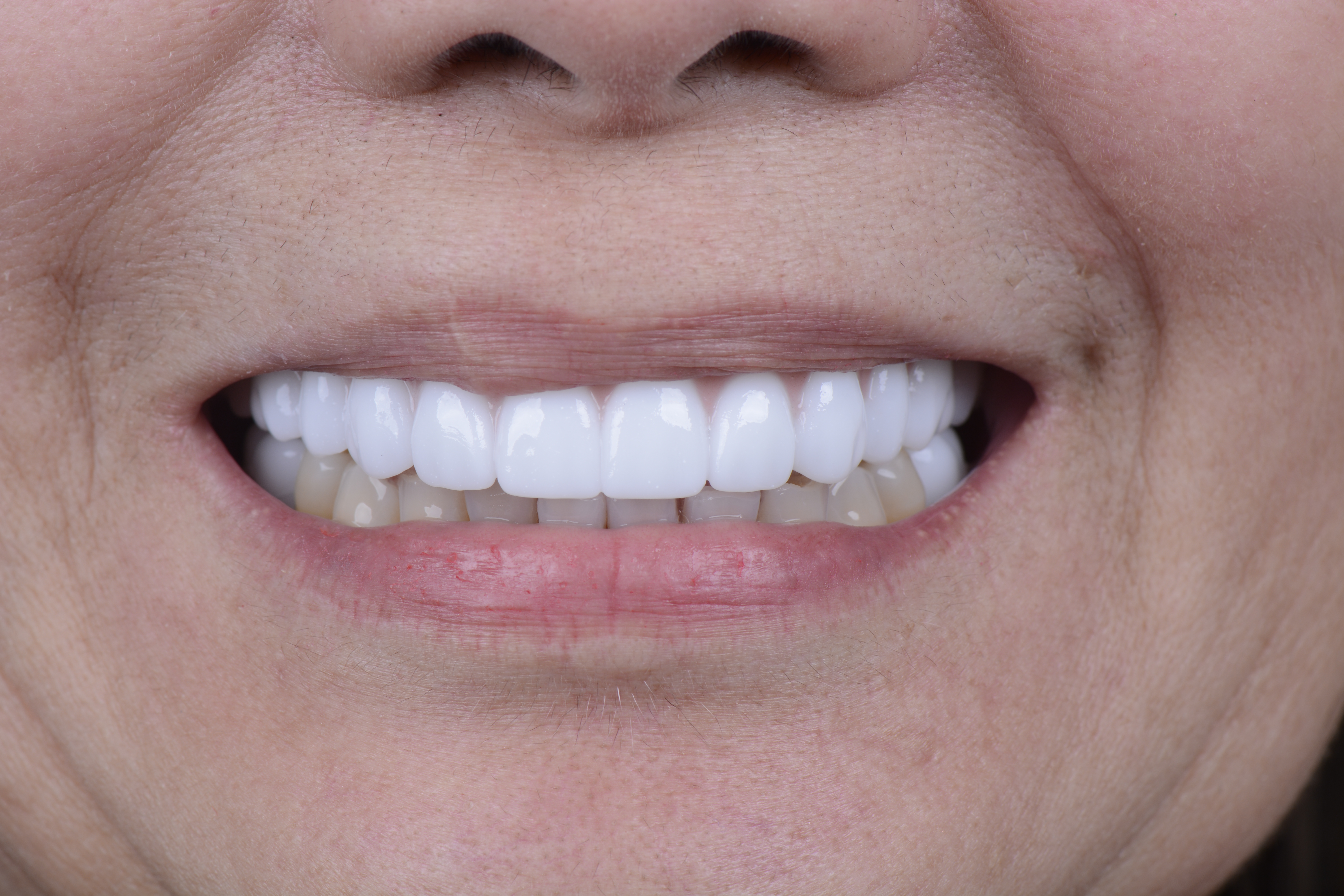 Clinical close-up of dental implants