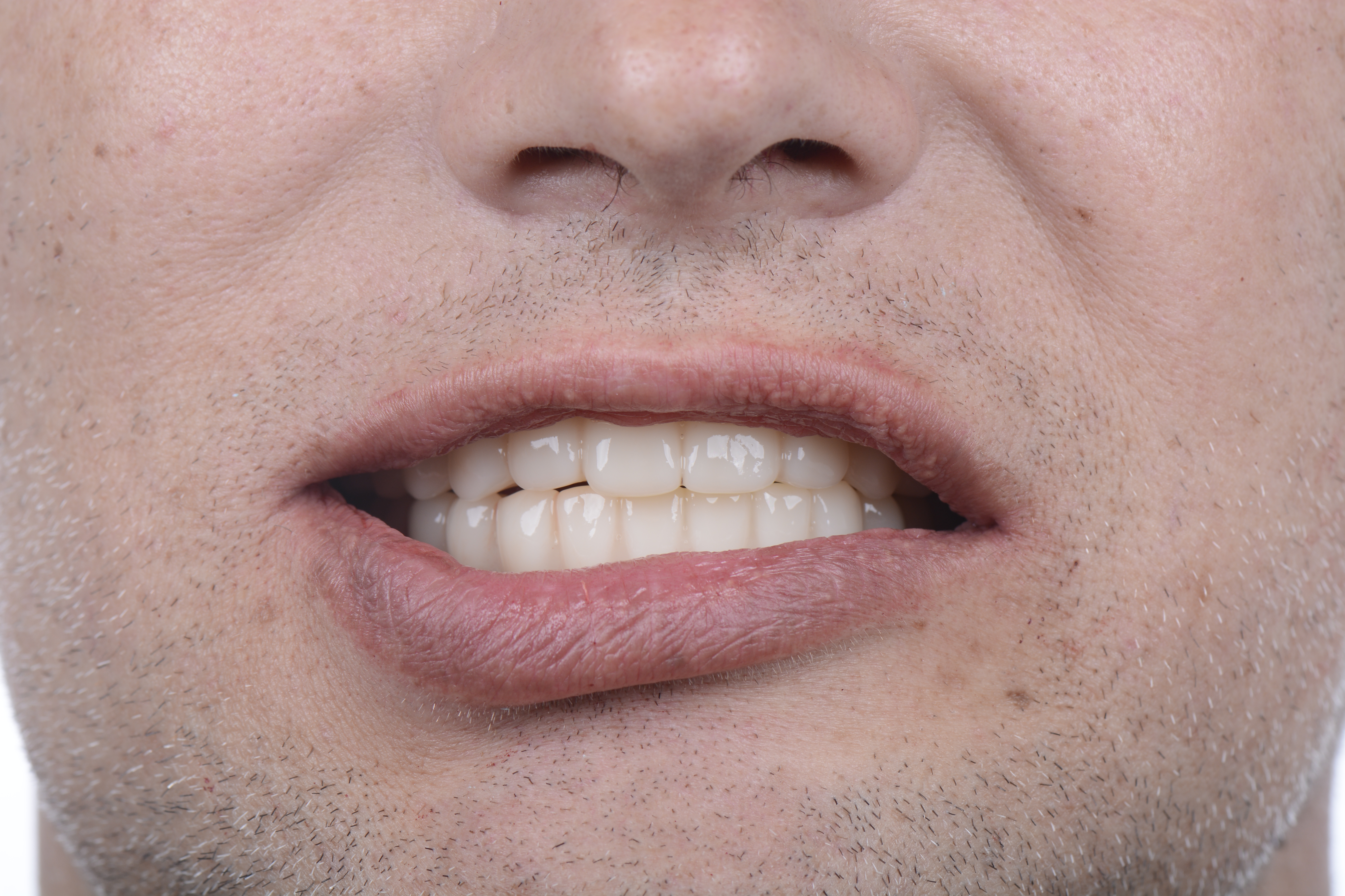 Clinical close-up of dental implants