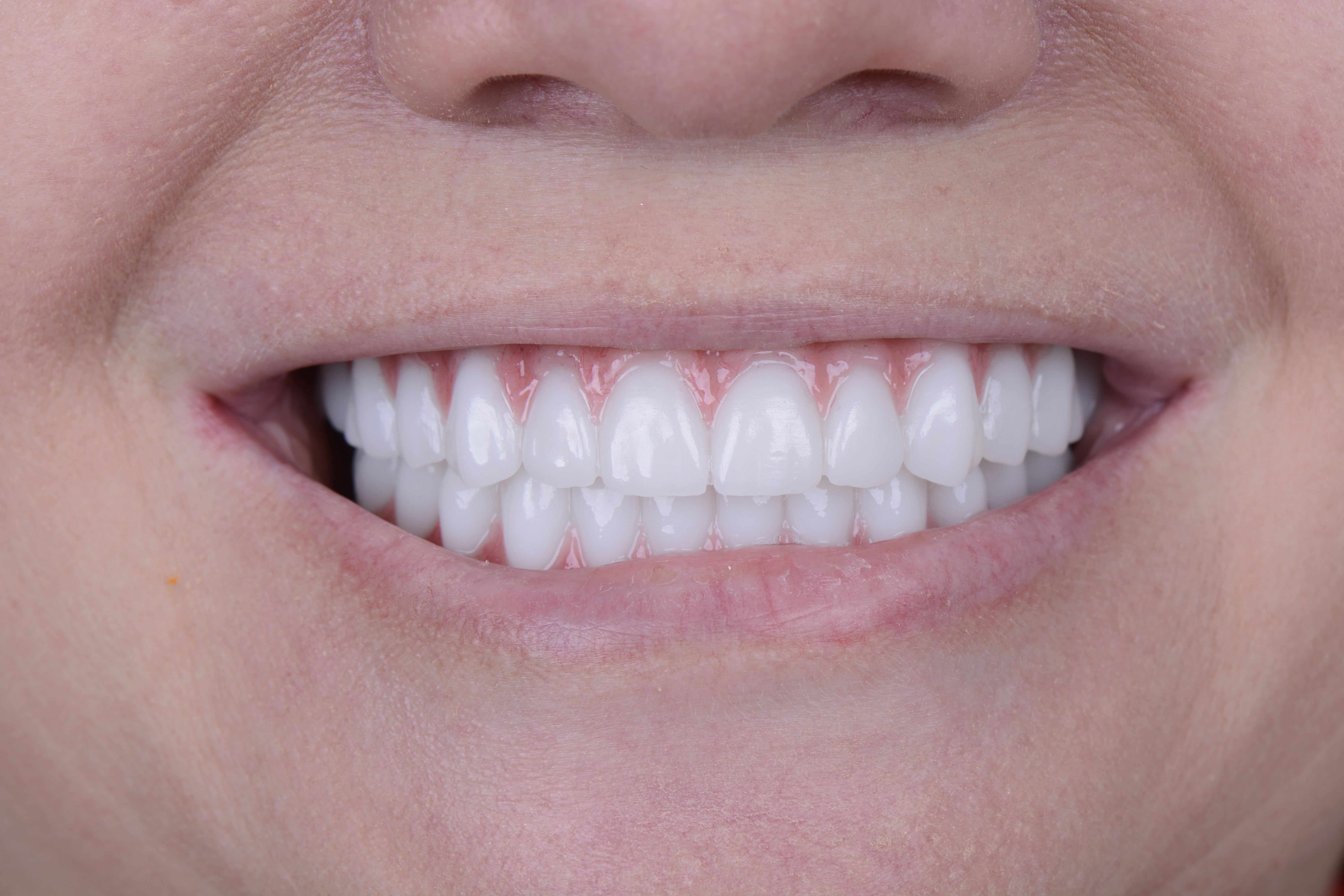 Clinical close-up of dental implants